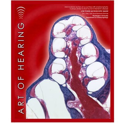 Art of Hearing Endolymphatic Hydrops Canvas Poster 20 x 24
