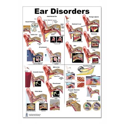 Blue Tree Ear Disorders educational poster, 24 by 36 inches